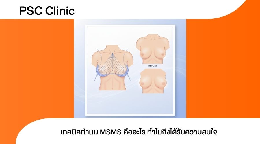 เทคนิคทำนม MSMS คืออะไร ทำไมถึงได้รับความสนใจ